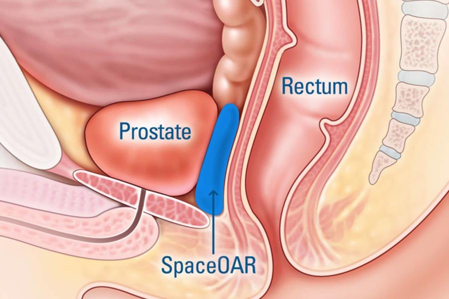 Surgeons give men a little "space" during prostate cancer treatment