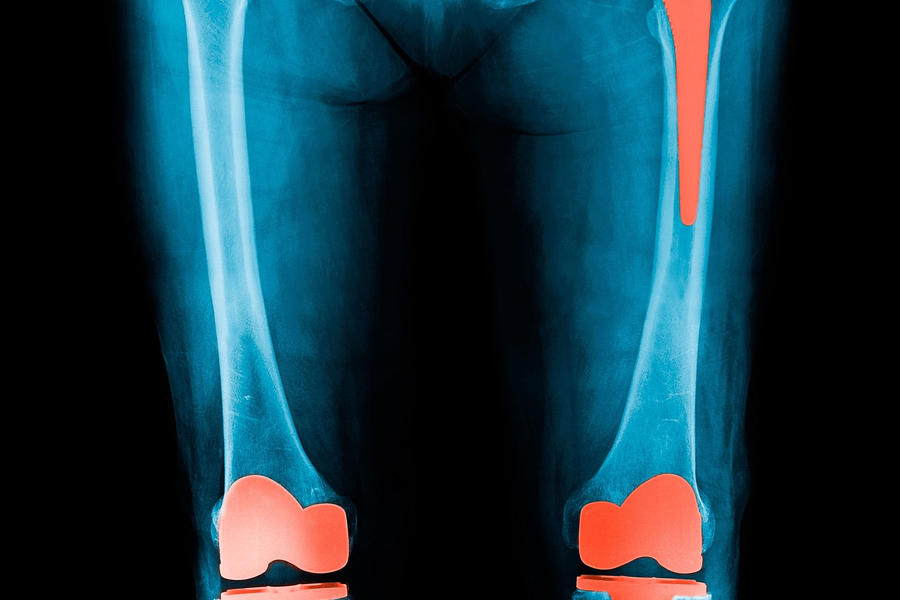 Xray of hip and knee