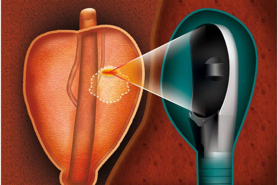 Focal One Ablation