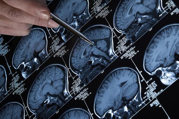 Brain scans