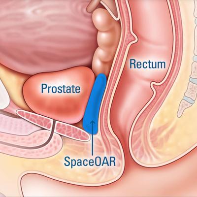 Surgeons give men a little "space" during prostate cancer treatment