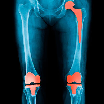 Xray of hip and knee