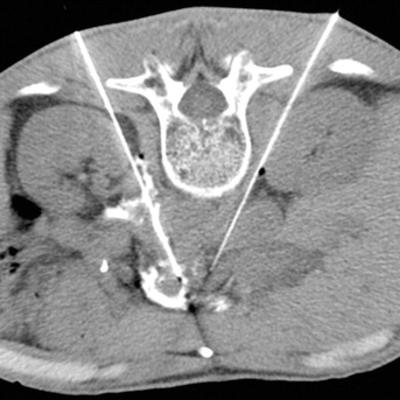 Radiology Celiac Neurolysis picture